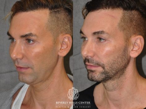 Beverly Hills Center Male Patient Before and After Profound MicroLift Treatment