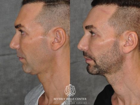 Beverly Hills Center Male Patient Before and After Profound MicroLift Treatment
