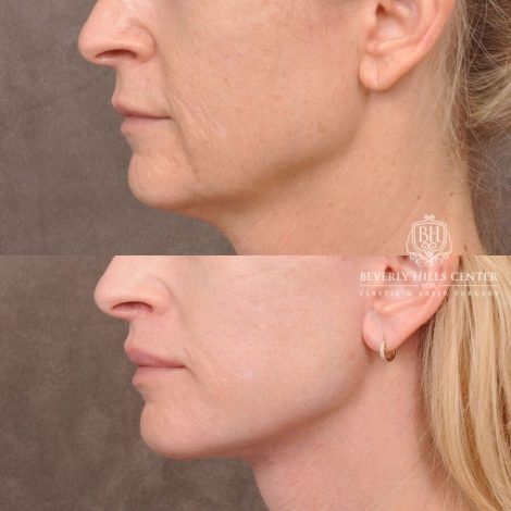 Beverly Hills Center Male Patient Before and After AuraLyft, Lip Lift and Co2 around the mouth
