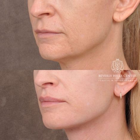 Beverly Hills Center Male Patient Before and After AuraLyft, Lip Lift and Co2 around the mouth