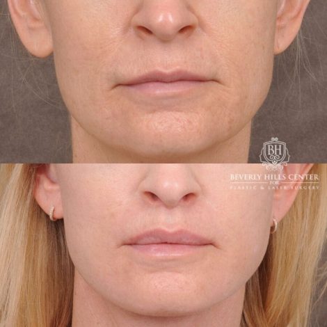 Beverly Hills Center Male Patient Before and After AuraLyft, Lip Lift and Co2 around the mouth