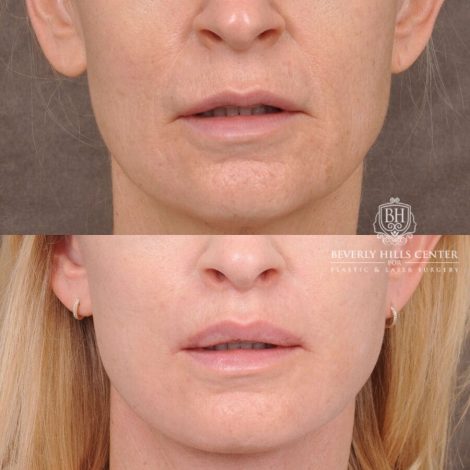 Beverly Hills Center Male Patient Before and After AuraLyft, Lip Lift and Co2 around the mouth