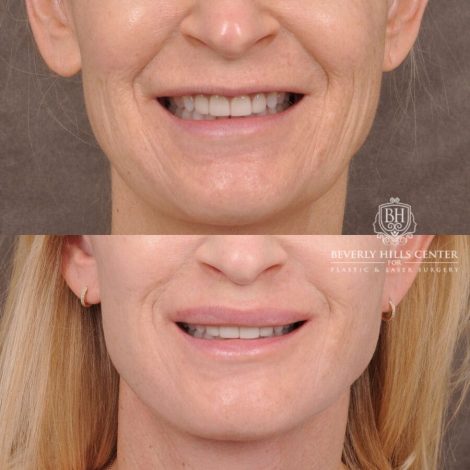 Beverly Hills Center Male Patient Before and After AuraLyft, Lip Lift and Co2 around the mouth