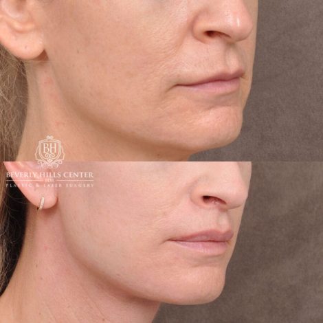 Beverly Hills Center Male Patient Before and After AuraLyft, Lip Lift and Co2 around the mouth