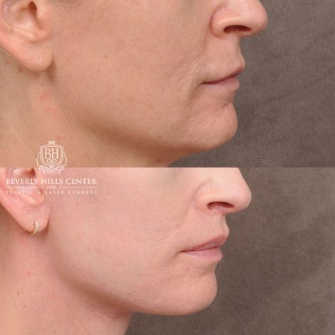 Beverly Hills Center Male Patient Before and After AuraLyft, Lip Lift and Co2 around the mouth