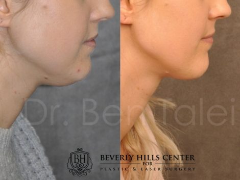 Beverly Hills Center Female Patient Before and After Microliposuction of Neck & Chin with Chin Tuck and Masseter Botox/Dysport Procedure