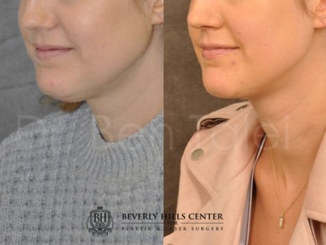 Beverly Hills Center Female Patient Before and After Microliposuction of Neck & Chin with Chin Tuck and Masseter Botox/Dysport Procedure