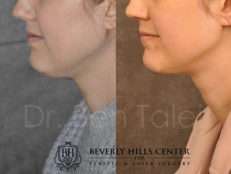 Beverly Hills Center Female Patient Before and After Microliposuction of Neck & Chin with Chin Tuck and Masseter Botox/Dysport Procedure
