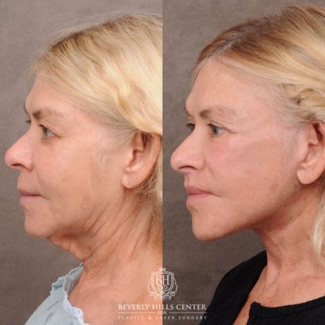Beverly Hills Center Female Patient Before and After AuraLyft, Lip Lift, Upper & Lower Blepharoplasty