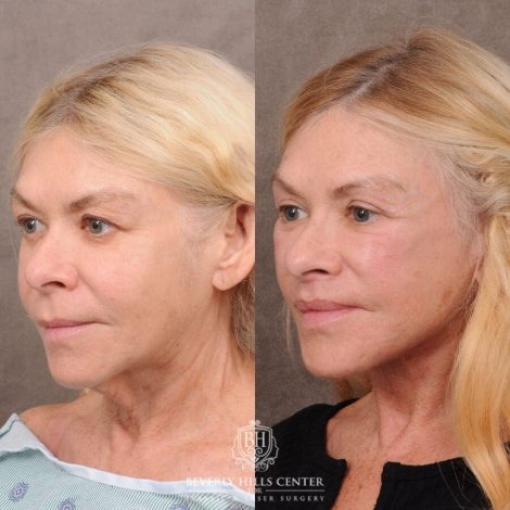 Beverly Hills Center Female Patient Before and After AuraLyft, Lip Lift, Upper & Lower Blepharoplasty