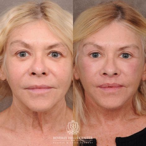 Beverly Hills Center Female Patient Before and After AuraLyft, Lip Lift, Upper & Lower Blepharoplasty