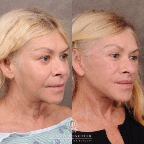 Beverly Hills Center Female Patient Before and After AuraLyft, Lip Lift, Upper & Lower Blepharoplasty