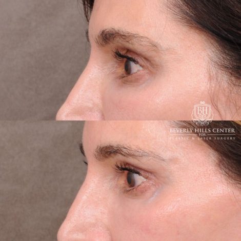 Beverly Hills Center Male Patient Before and After Auralyft, TCA on under eyes, Upper Blepharoplasty, Lip Lift