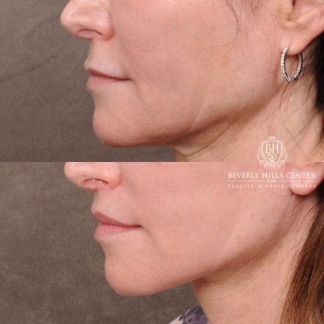 Beverly Hills Center Male Patient Before and After Auralyft, TCA Peel under Eyes, Upper Blepharoplasty, Lip Lift