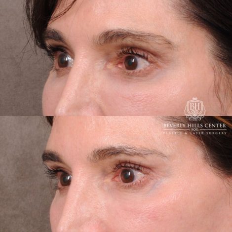 Beverly Hills Center Male Patient Before and After Auralyft, TCA on under eyes, Upper Blepharoplasty, Lip Lift