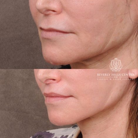 Beverly Hills Center Male Patient Before and After Auralyft, TCA Peel under Eyes, Upper Blepharoplasty, Lip Lift