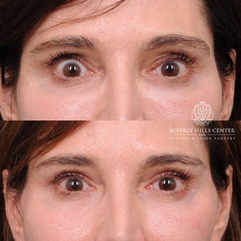 Beverly Hills Center Male Patient Before and After Auralyft, TCA on under eyes, Upper Blepharoplasty, Lip Lift
