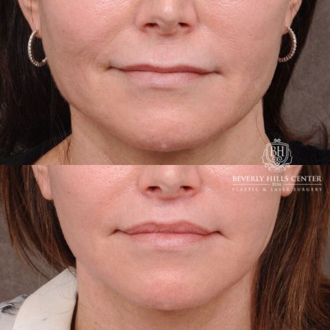 Beverly Hills Center Male Patient Before and After Auralyft, TCA Peel under Eyes, Upper Blepharoplasty, Lip Lift