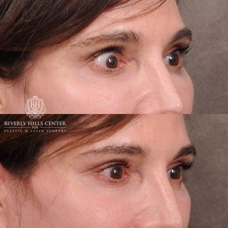 Beverly Hills Center Male Patient Before and After Auralyft, TCA on under eyes, Upper Blepharoplasty, Lip Lift
