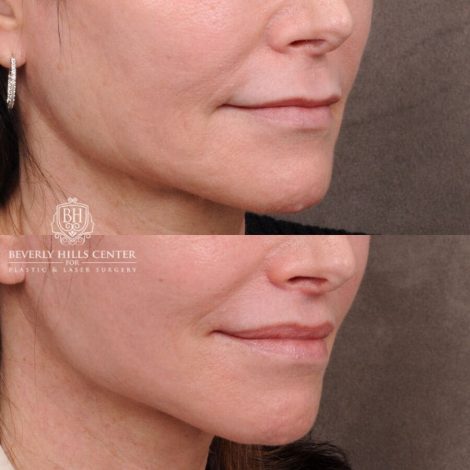 Beverly Hills Center Male Patient Before and After Auralyft, TCA Peel under Eyes, Upper Blepharoplasty, Lip Lift