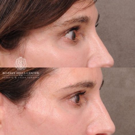 Beverly Hills Center Male Patient Before and After Auralyft, TCA on under eyes, Upper Blepharoplasty, Lip Lift