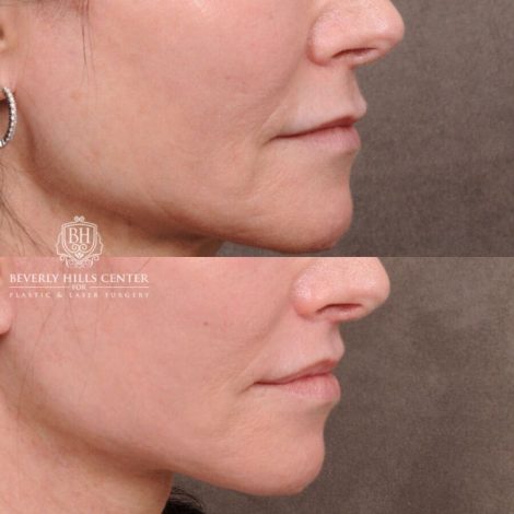 Beverly Hills Center Male Patient Before and After Auralyft, TCA Peel under Eyes, Upper Blepharoplasty, Lip Lift