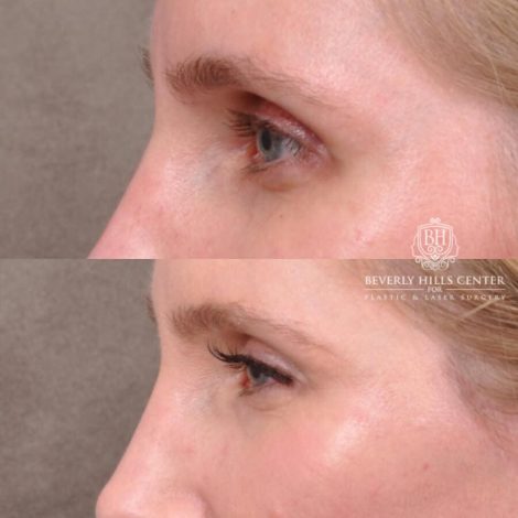Beverly Hills Center Female Patient Before and After FatGrafting, UpperEyelid, CUPID LIFT® Corner Lift