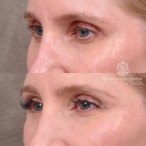 Beverly Hills Center Female Patient Before and After FatGrafting, UpperEyelid, CUPID LIFT® Corner Lift