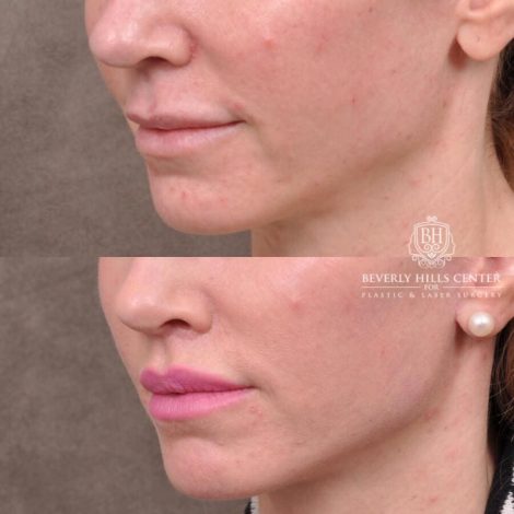 Beverly Hills Center Female Patient Before and After FatGrafting, UpperEyelid, CUPID LIFT® Corner Lift