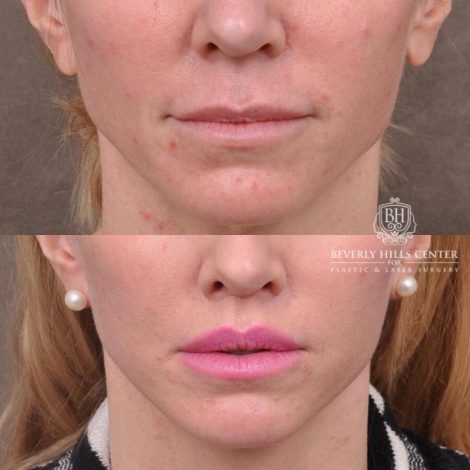 Beverly Hills Center Female Patient Before and After FatGrafting, UpperEyelid, CUPID LIFT® Corner Lift