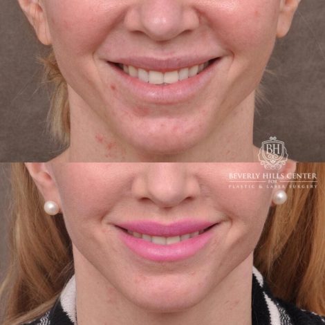 Beverly Hills Center Female Patient Before and After FatGrafting, UpperEyelid, CUPID LIFT® Corner Lift