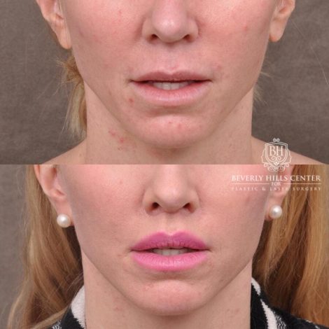 Beverly Hills Center Female Patient Before and After FatGrafting, UpperEyelid, CUPID LIFT® Corner Lift