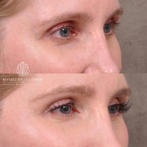 Beverly Hills Center Female Patient Before and After FatGrafting, UpperEyelid, CUPID LIFT® Corner Lift