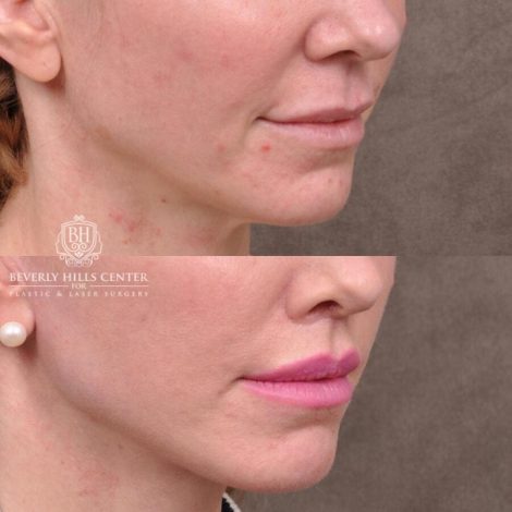 Beverly Hills Center Female Patient Before and After FatGrafting, UpperEyelid, CUPID LIFT® Corner Lift