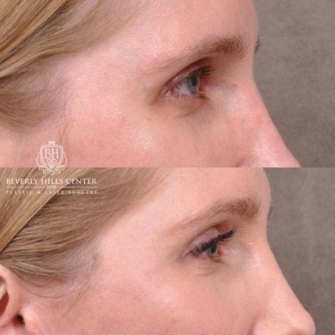Beverly Hills Center Female Patient Before and After FatGrafting, UpperEyelid, CUPID LIFT® Corner Lift
