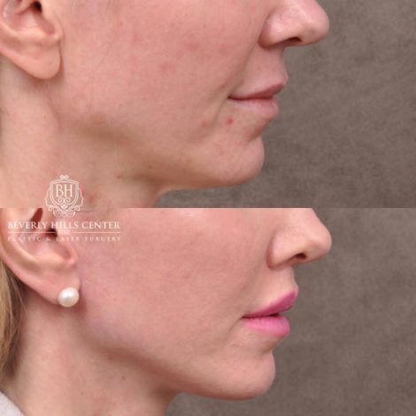 Beverly Hills Center Female Patient Before and After FatGrafting, UpperEyelid, CUPID LIFT® Corner Lift