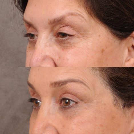 Beverly Hills Center Female Patient Before and After Brow Lift, Upper Blepharoplasty,TCA Peel under the eyes