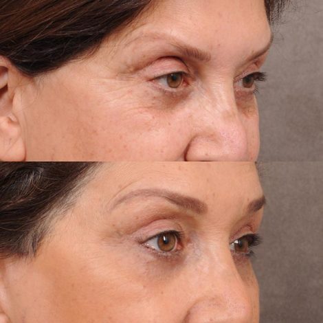Beverly Hills Center Female Patient Before and After Brow Lift, Upper Blepharoplasty,TCA Peel under the eyes