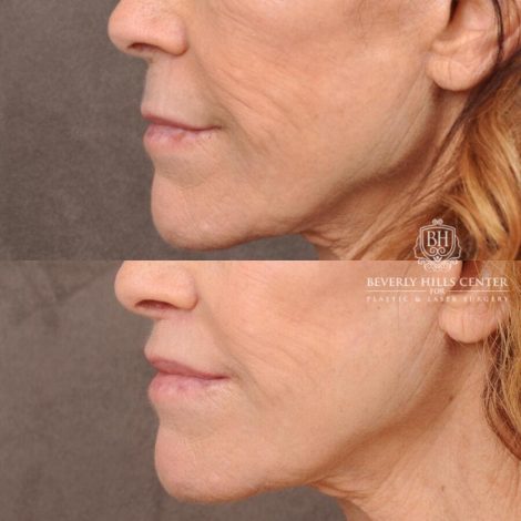 Beverly Hills Center Male Patient Before and After Lip Lift