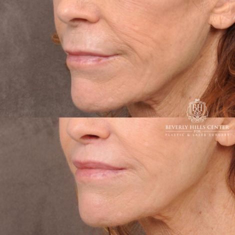 Beverly Hills Center Male Patient Before and After Lip Lift