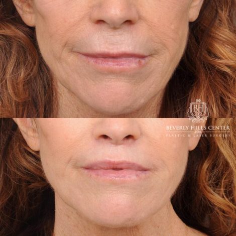 Beverly Hills Center Male Patient Before and After Lip Lift