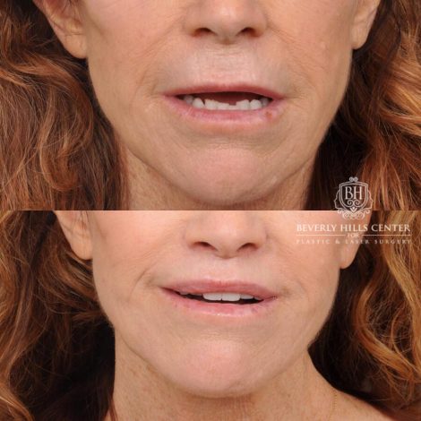 Beverly Hills Center Male Patient Before and After Lip Lift