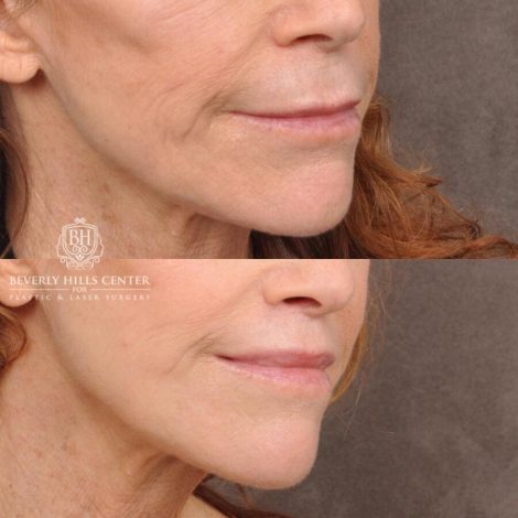 Beverly Hills Center Male Patient Before and After Lip Lift