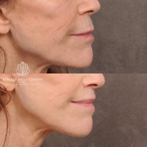 Beverly Hills Center Male Patient Before and After Lip Lift