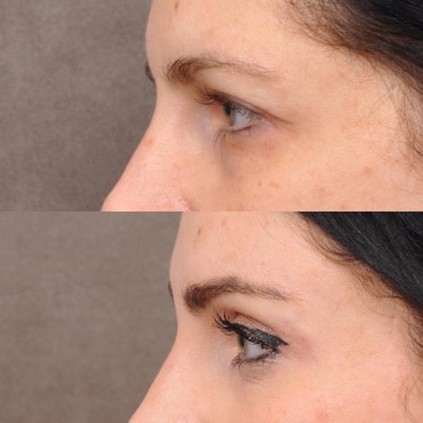 Beverly Hills Center Female Patient Endoscopic Brow Lift & Upper Blepharoplasty