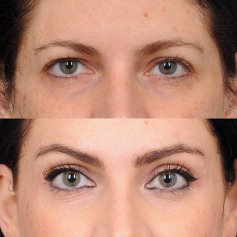 Beverly Hills Center Female Patient Endoscopic Brow Lift & Upper Blepharoplasty