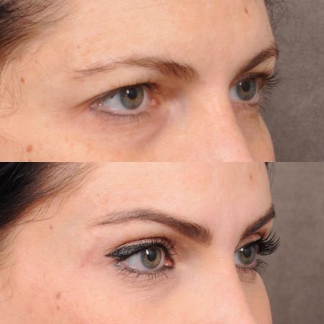 Beverly Hills Center Female Patient Endoscopic Brow Lift & Upper Blepharoplasty