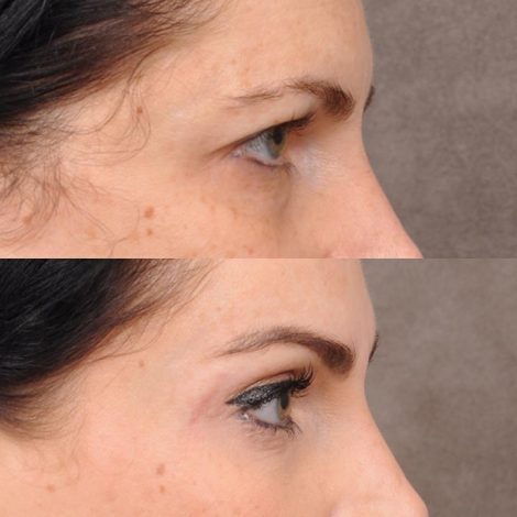 Beverly Hills Center Female Patient Endoscopic Brow Lift & Upper Blepharoplasty