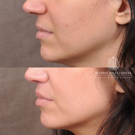 Beverly Hills Center Male Patient Before and After Lip Lift