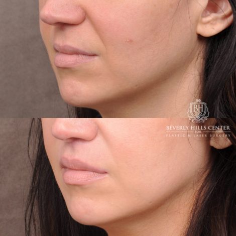 Beverly Hills Center Male Patient Before and After Lip Lift